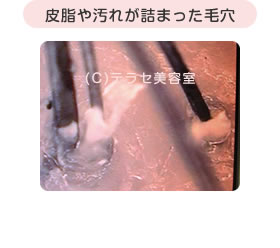 皮脂や汚れが詰まった毛穴