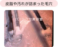 皮脂や汚れが詰まった毛穴