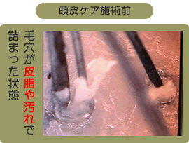 頭皮ケア施術前 ビフォーアフター 毛穴が皮脂や汚れで詰まった状態