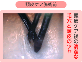 頭皮ケア施術後 ビフォーアフター 頭皮ケア後の清潔な毛穴と頭皮のツヤ