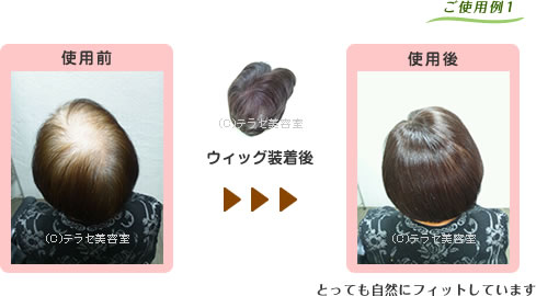 ウィッグ装着後 使用前・使用後の写真 とても自然にフィットしています