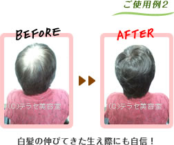 使用例2ビフォー・アフター 白髪の伸びてきた生え際にも自信が出てきます